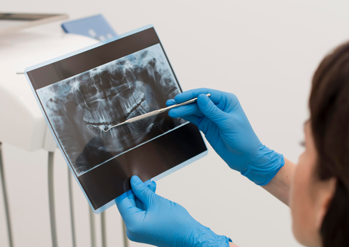 Cirugía Guiada en Implantes Dentales ¿Siempre es necesaria? 5 radiografía oral para implantes dentales