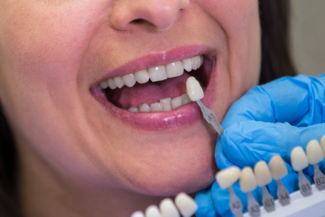 Cirugía Guiada en Implantes Dentales ¿Siempre es necesaria? 2 zona estética anterior