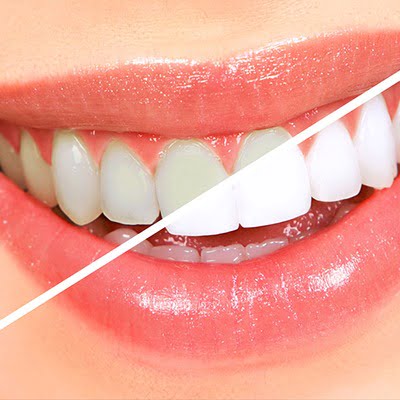Servicios Implantsite -Odontología Estética en Dos Hermanas
