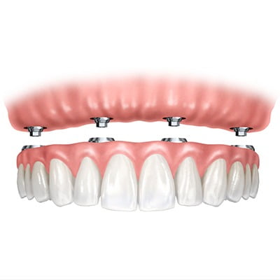 Servicios Implantsite -Prótesis dental en Dos Hermanas