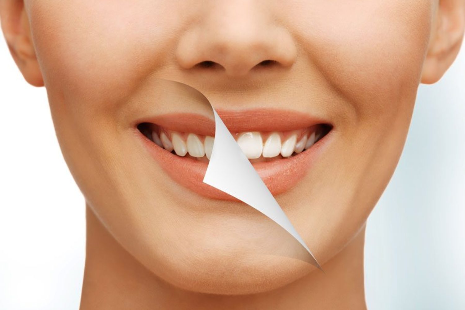 post-blanqueamiento-dental