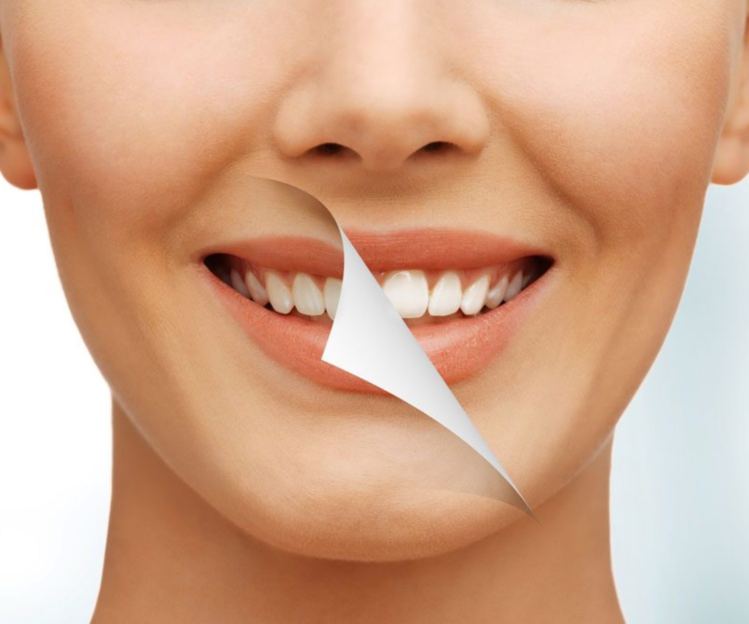 post-blanqueamiento-dental