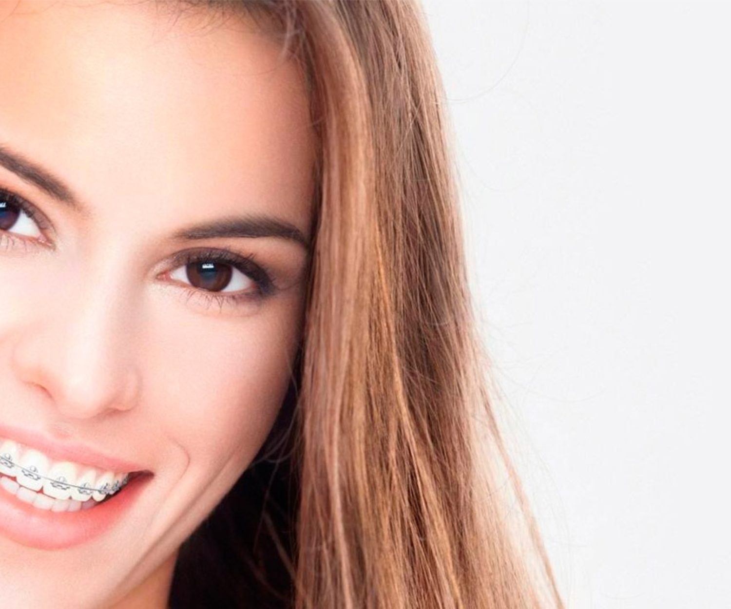Chica sonriente con una ortodoncia compuesta por brackets convencionales