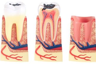 la caries perjudica tanto el diente afectado como todo el entorno bucodental