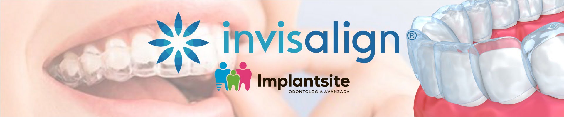 ortodoncia invisible, en clínica dental Implantsite somos expertos en invisalign