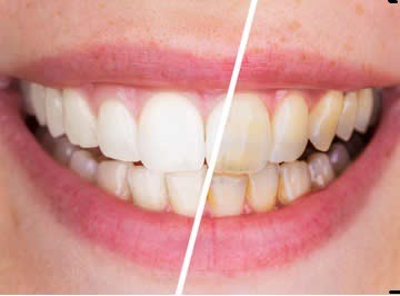imagen que muestra los resultados del blanqueamiento dental con láser
