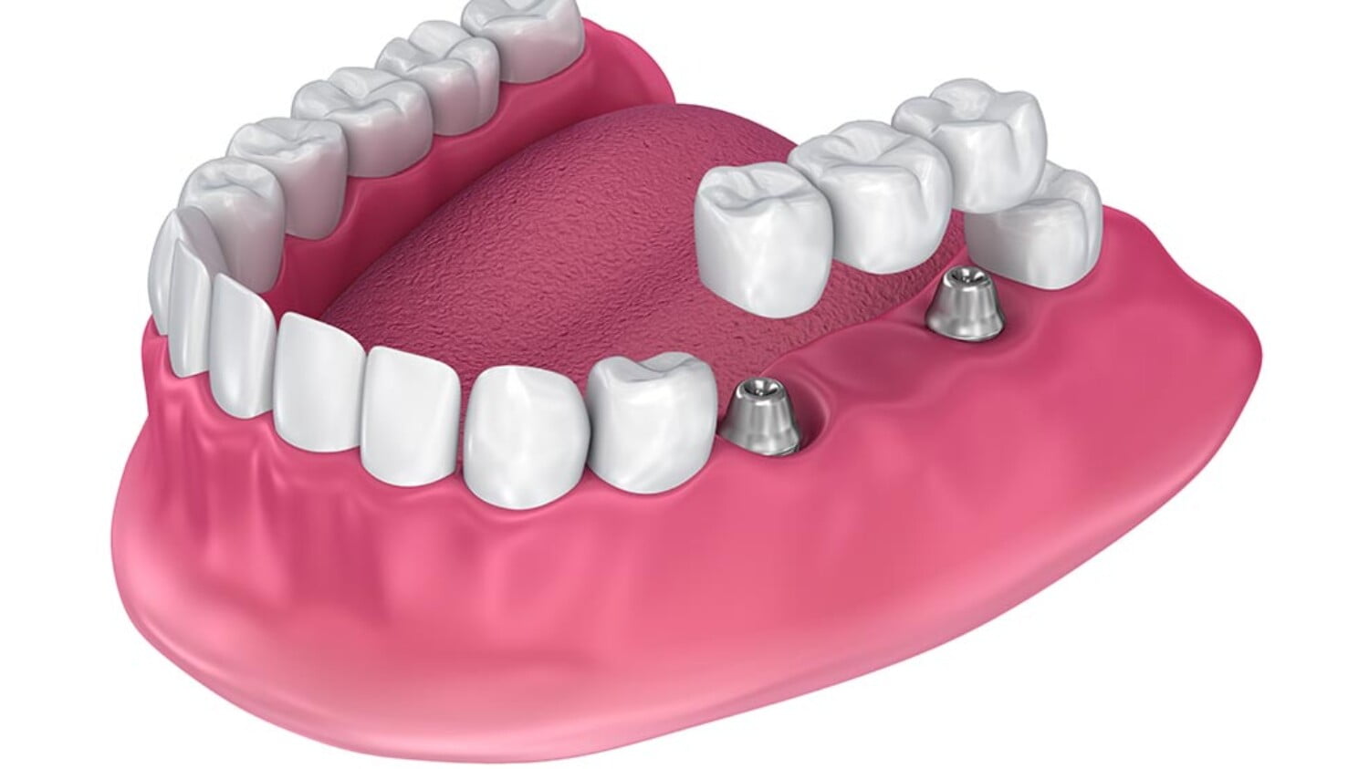 ejemplo de implantes parciales