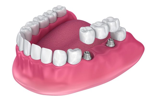 ejemplo de implantes parciales