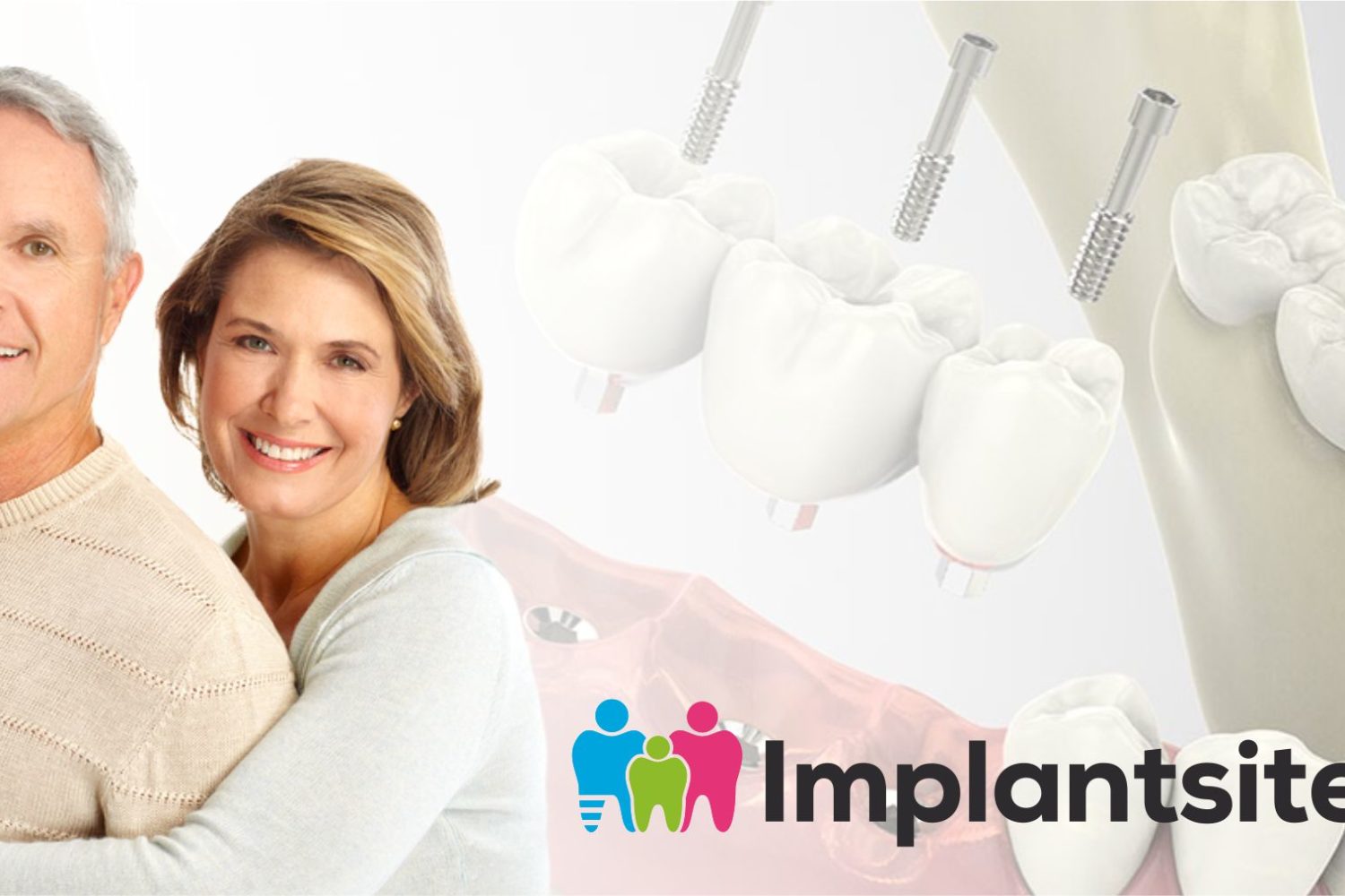 pareja sonriendo que usa implantes