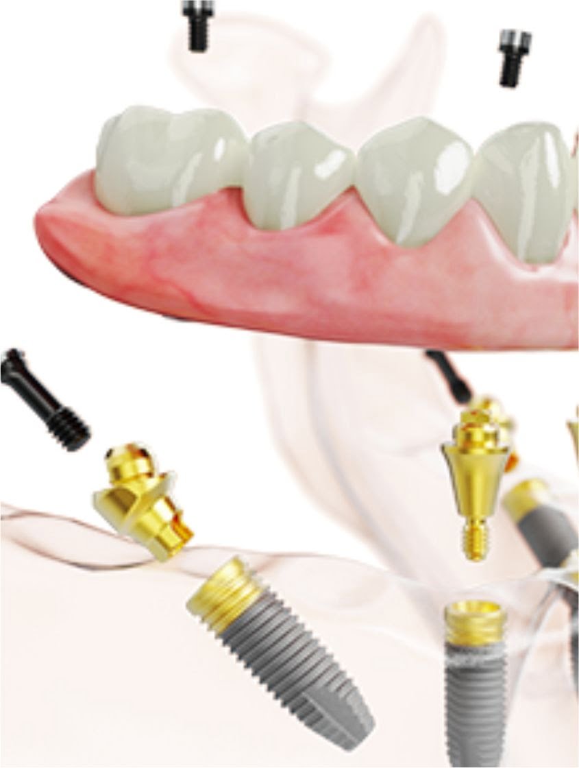 implantes dentales, reproducción digital