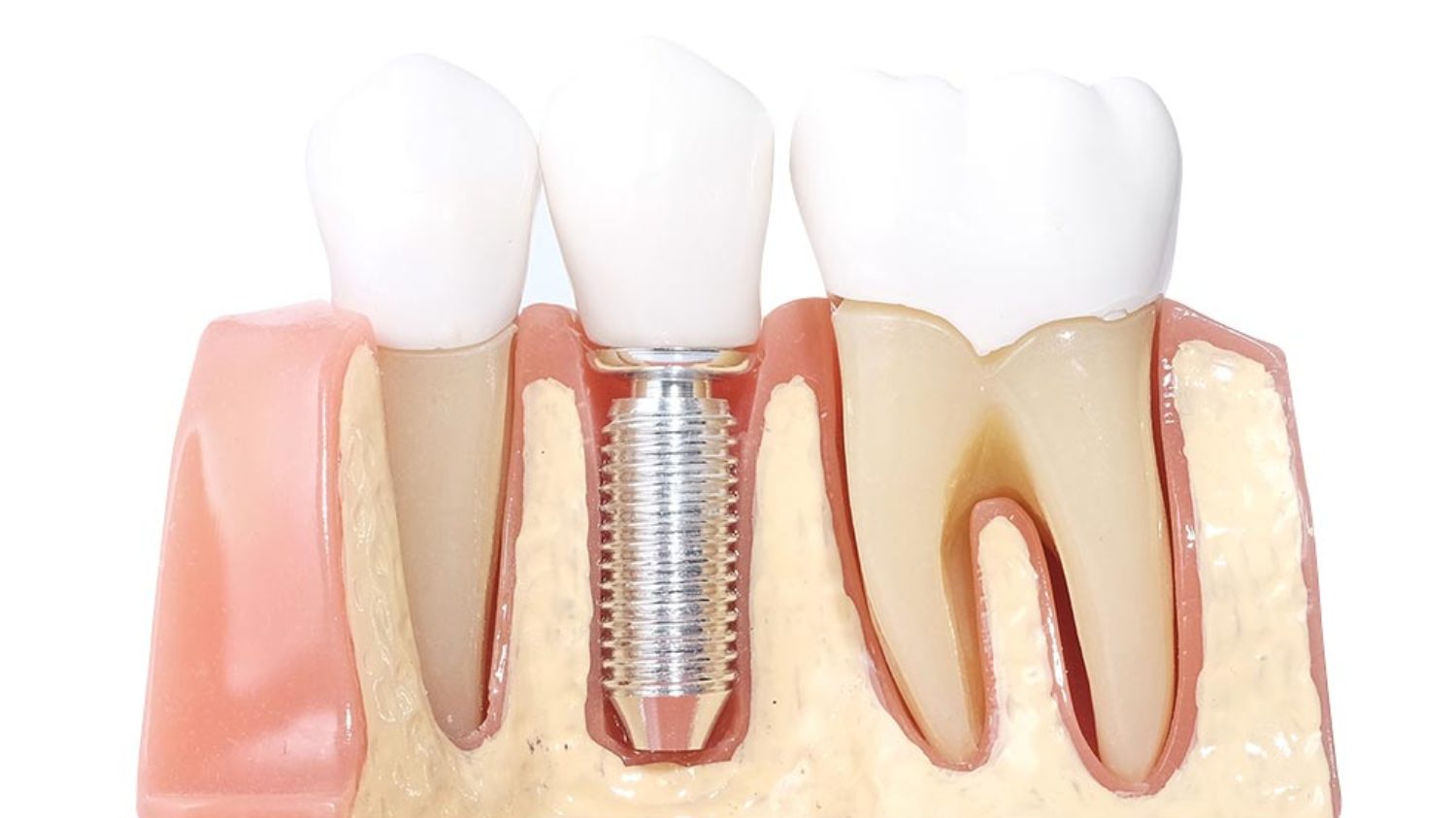 imagen de implante unitario