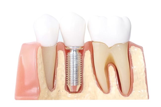 imagen de implante unitario