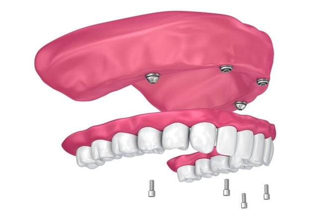 rehabilitación completa de dentadura con implantes dentales