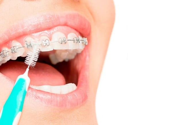cepillo interdental que debes llevar contigo para cuidar tu ortodoncia