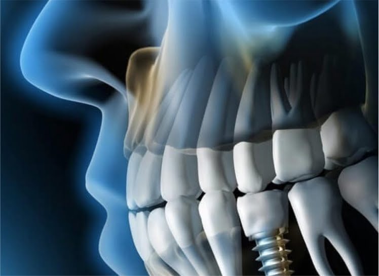 El TAC dental: La importancia de un buen diagnóstico 1 imagen tridimensional de dentadura que se consigue gracias al TAC dental