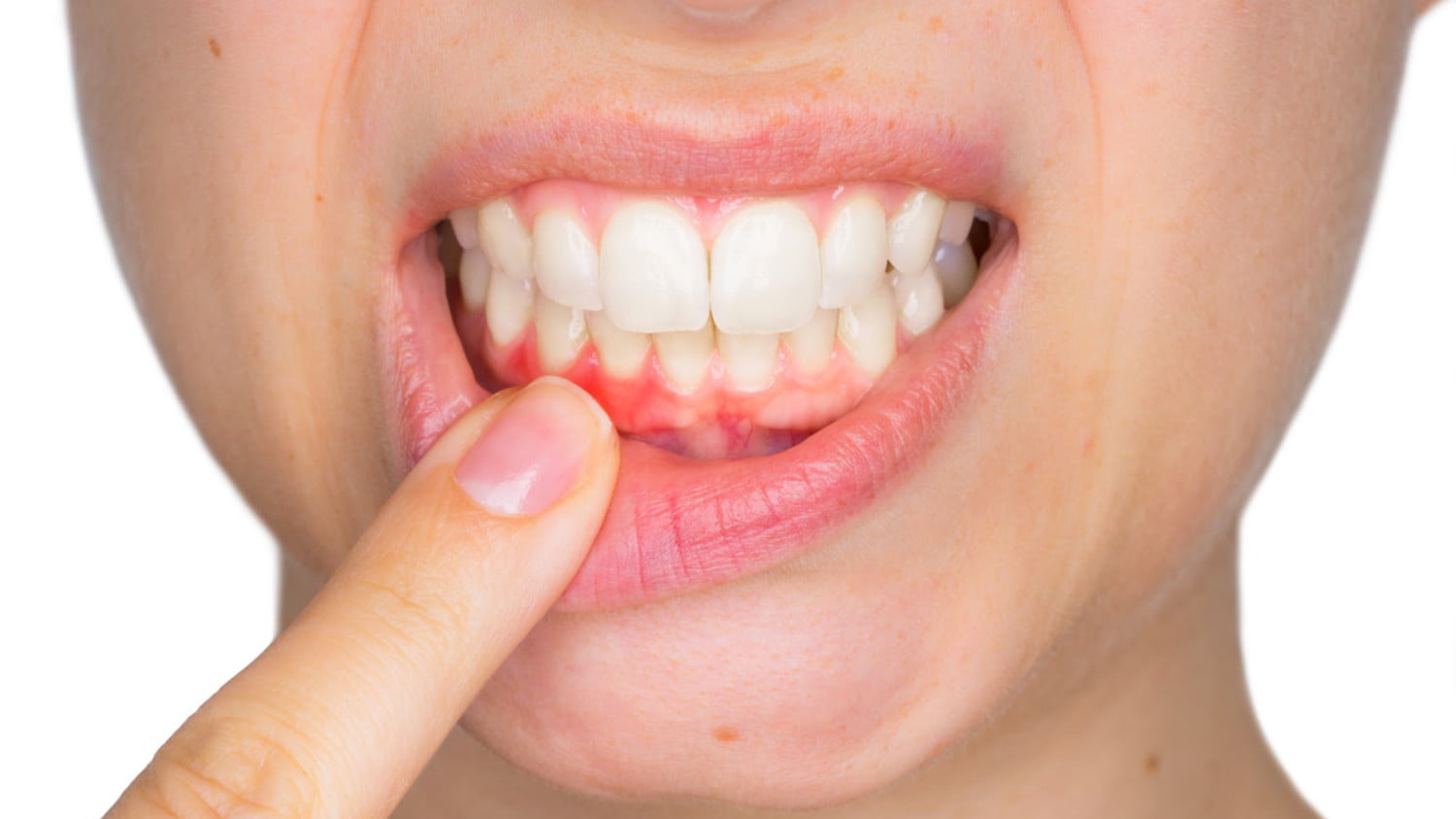 ¿Por qué sangran las encías?¿Hay algún remedio para evitarlo? 5 mujer señalando sus dientes porque le sangran las encías