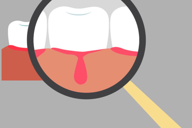 ¿Por qué sangran las encías?¿Hay algún remedio para evitarlo? 4 por qué sangran las encías?