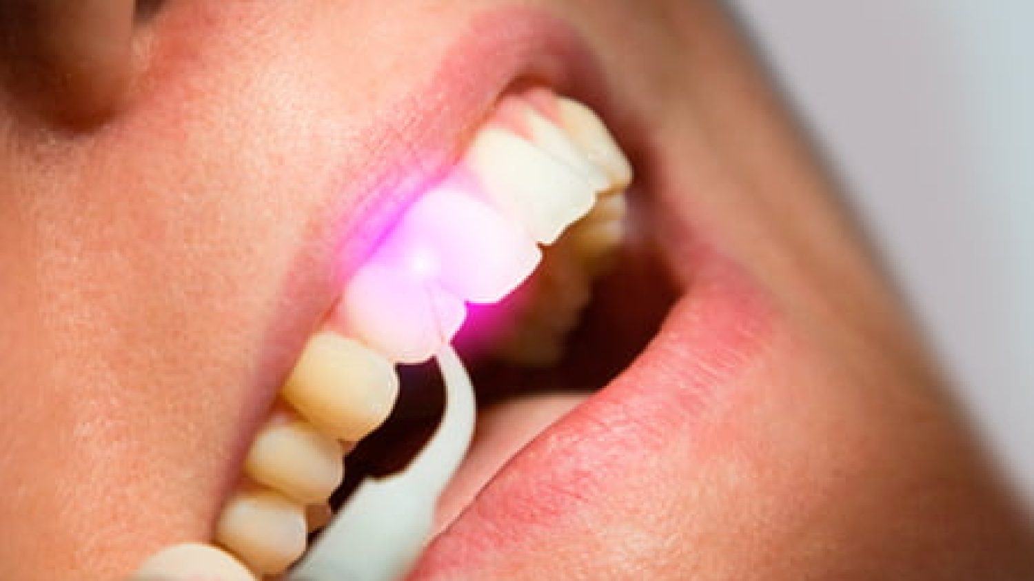 imagen de aplicación de un tipo de láser dental