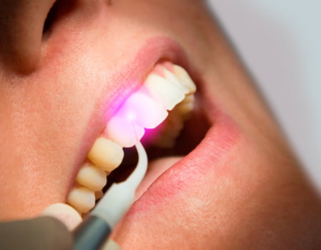 imagen de aplicación de un tipo de láser dental