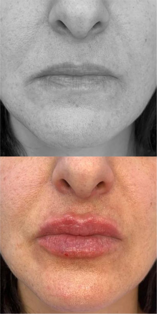 antes y despues relleno con ácido hialurónico