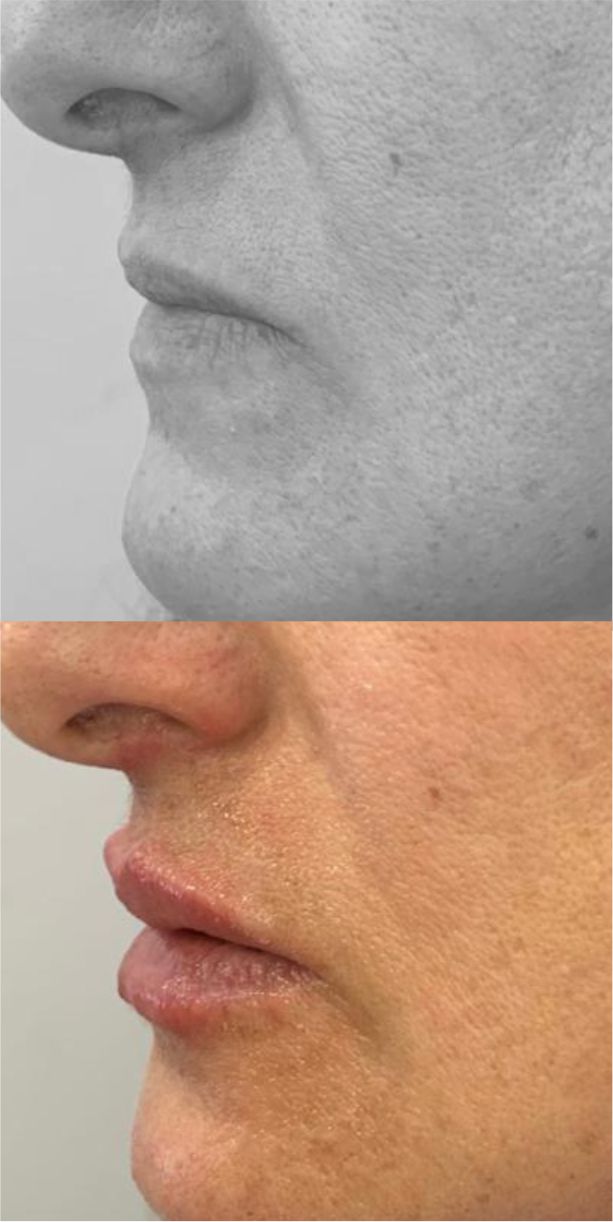 Antes y después de una paciente tras tratamiento de relleno labial con ácido hialurónico en Clínica Implantsite