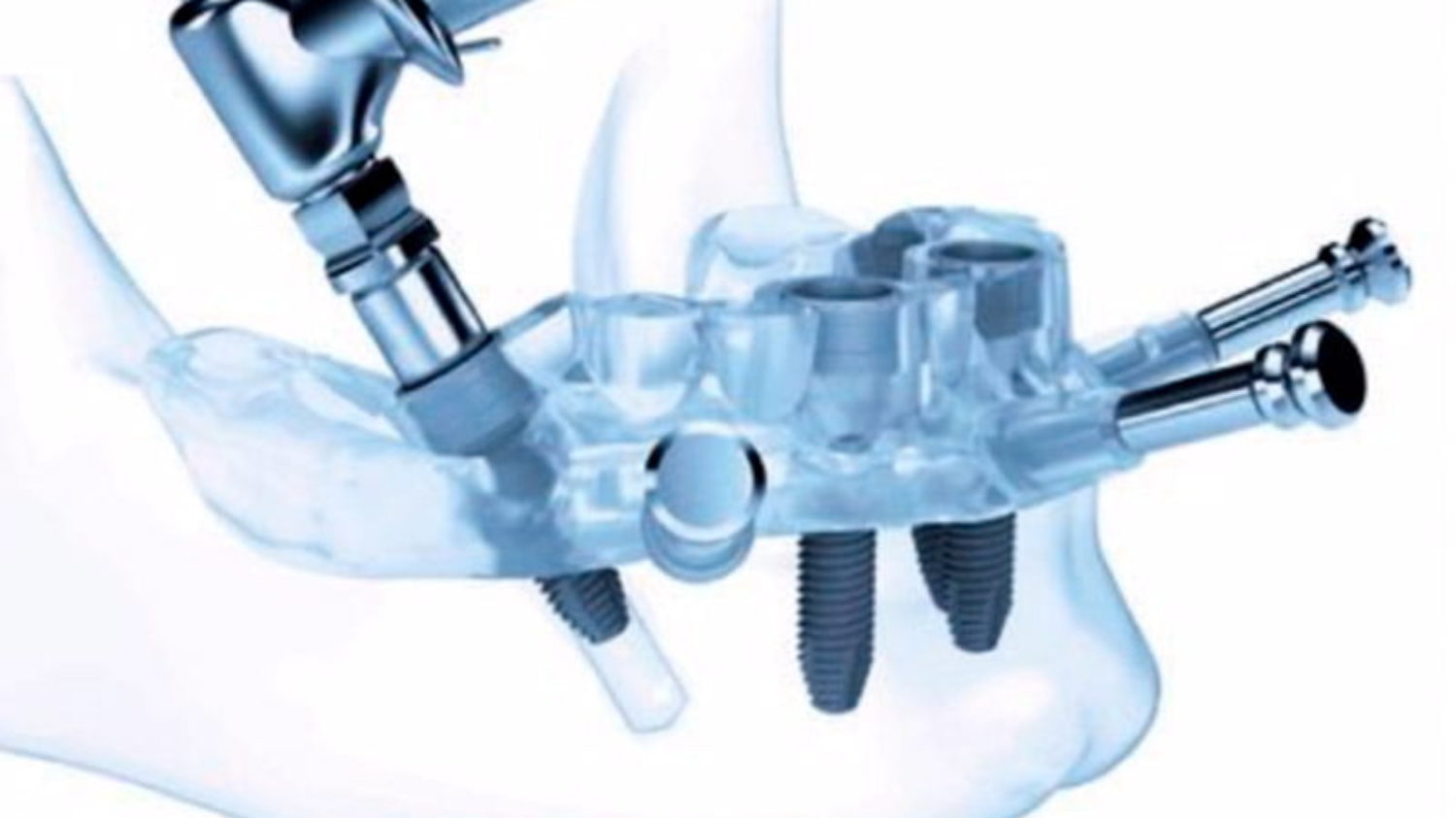 Rehabilitación estética con prótesis de Zirconio - Caso real 3 cirugia guiada implantes dentales