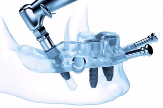 cirugia guiada implantes dentales
