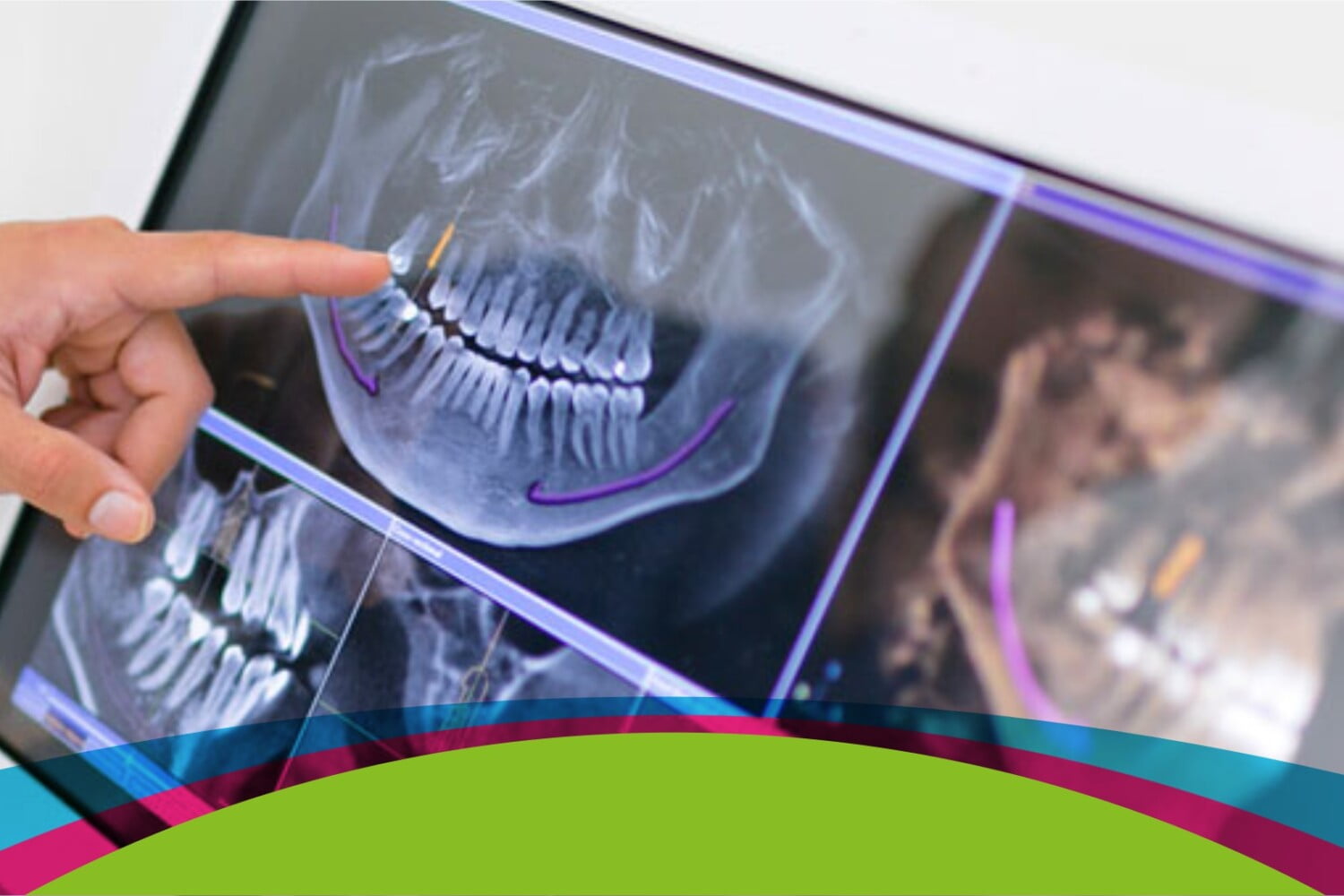 ejemplo de cirugía guiada en implantes dentales