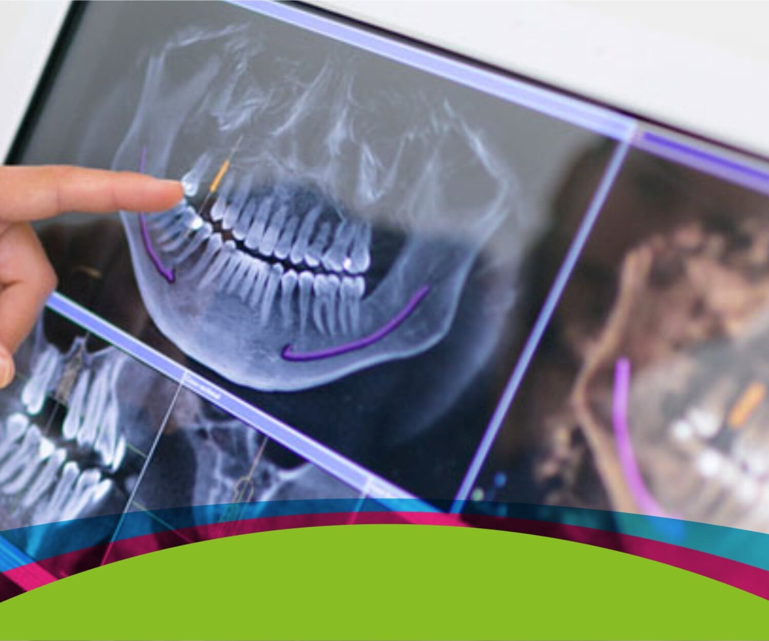 ejemplo de cirugía guiada en implantes dentales