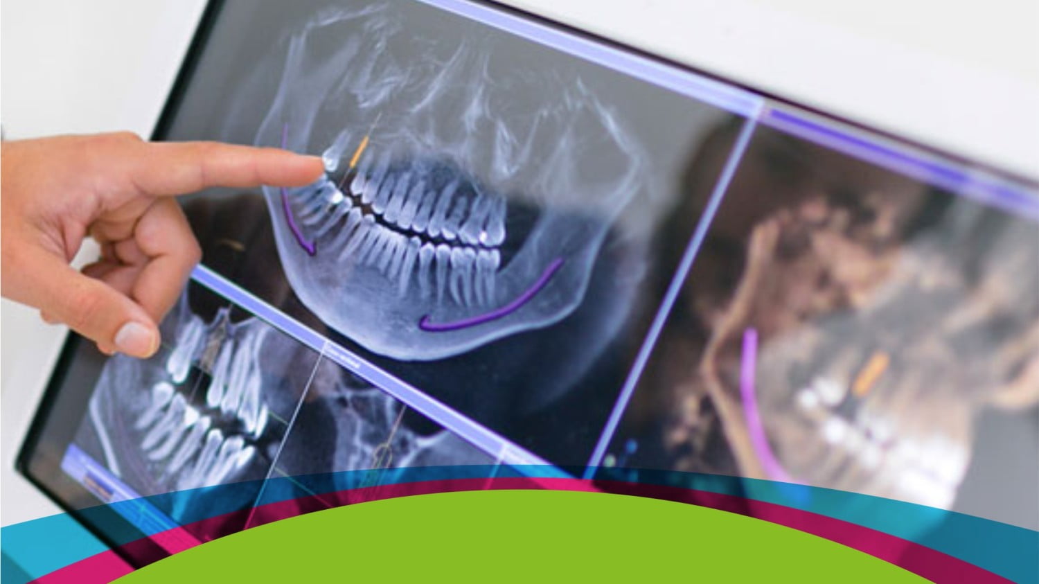 ejemplo de cirugía guiada en implantes dentales