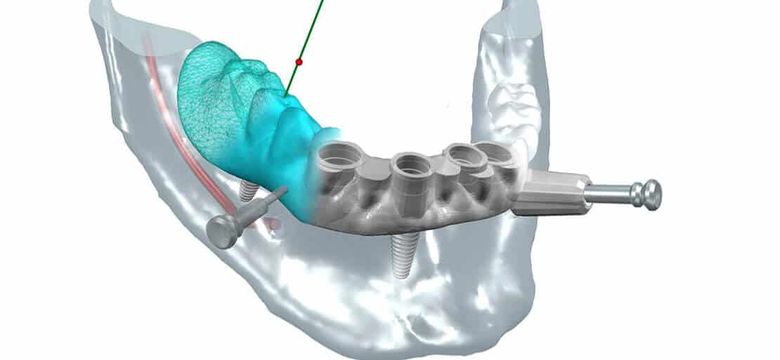 implantes de carga inmediata