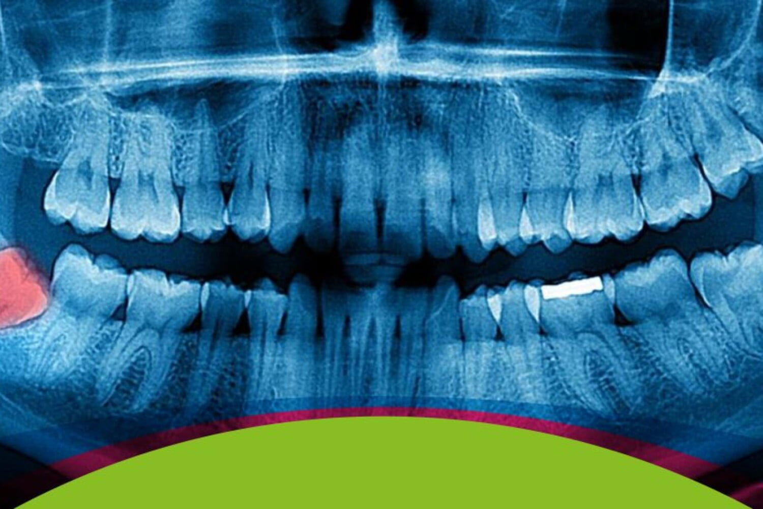 imagen representativa de problemas con las muelas del juicio