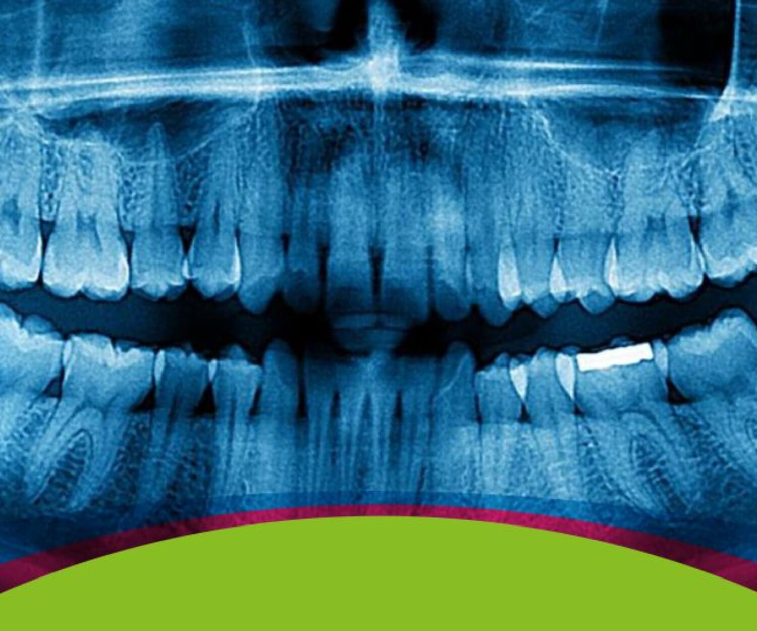 imagen representativa de problemas con las muelas del juicio