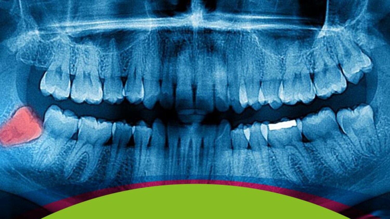 imagen representativa de problemas con las muelas del juicio
