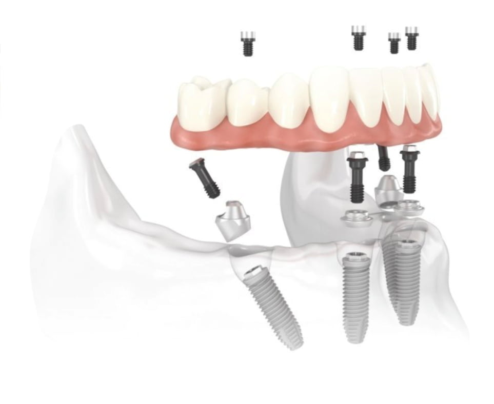 implantes carga inmediata ejemplo
