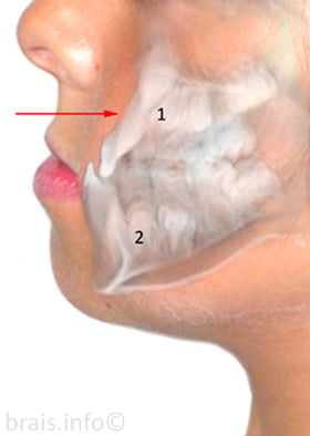 Perfil de un niño con retrognatismo maxilar con superposición de radiografía de perfil, antes del tratamiento de ortodoncia y ortopedia dentofacial.