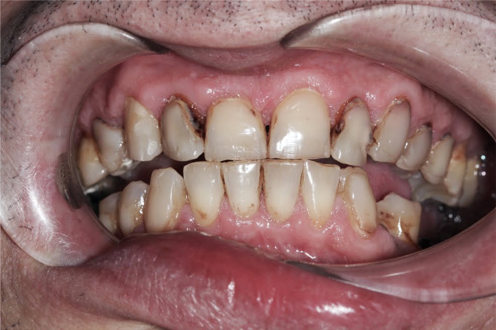 Rehabilitación estética con prótesis de Zirconio - Caso real 1 Imagen de antes de comenzar el tratamiento de rehabilitación estética