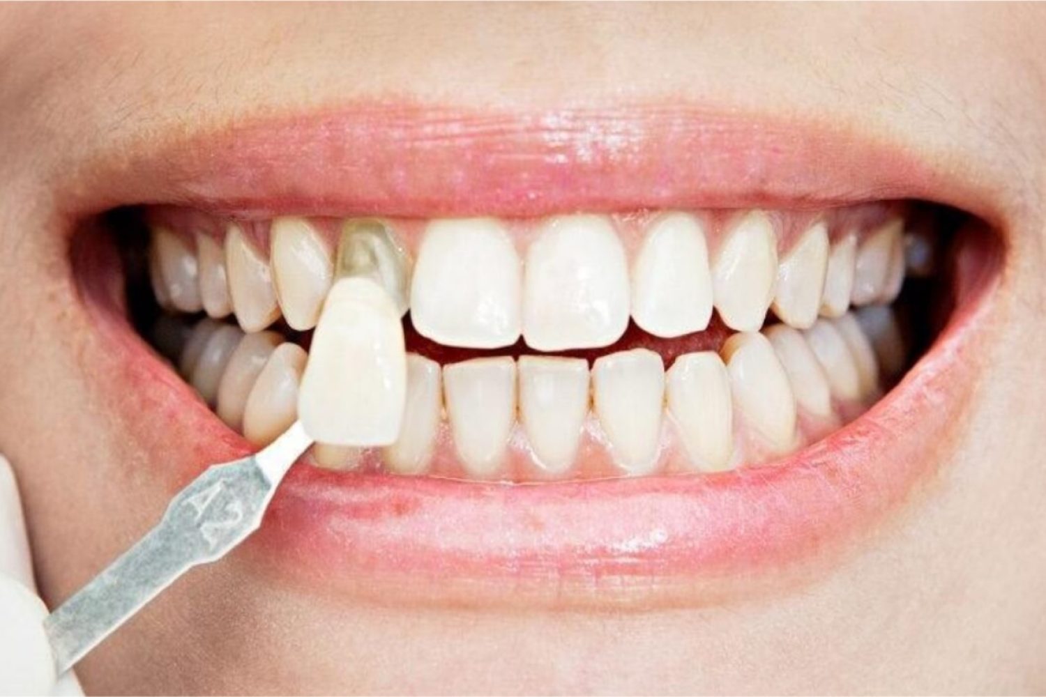 ejemplo de tratamiento de carillas dentales