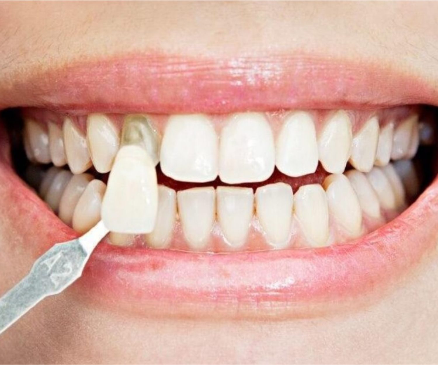 ejemplo de tratamiento de carillas dentales