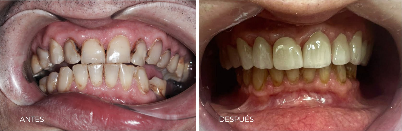 Rehabilitación estética con prótesis de Zirconio - Caso real 4 antes y después de la rehabilitación estética de nuestro paciente