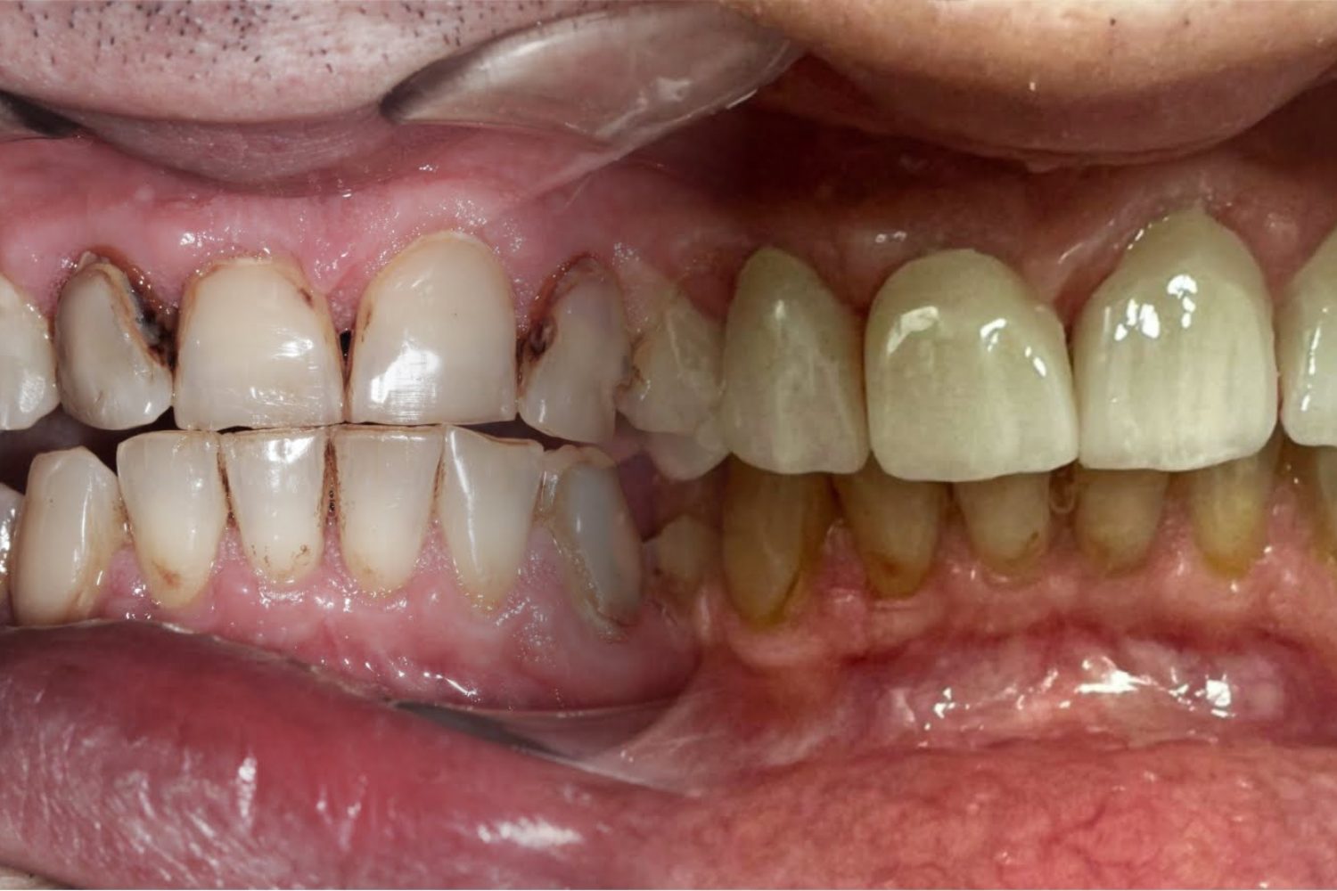 antes y después del tratamiento de rehabilitación estética dental a un paciente