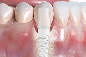 Rehabilitación estética con prótesis de Zirconio - Caso real 2 implante de zirconio