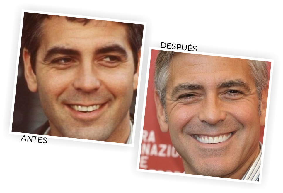 Carillas dentales: una sonrisa de película 3 george clooney carillas implantsite