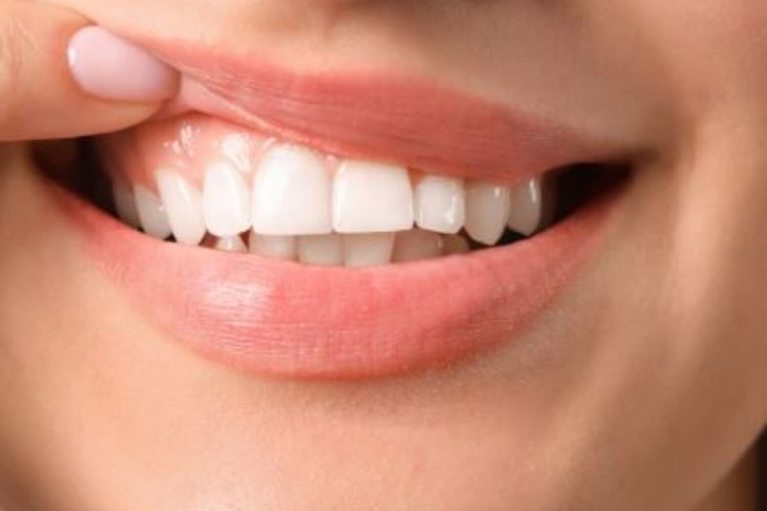 sonrisa gingival