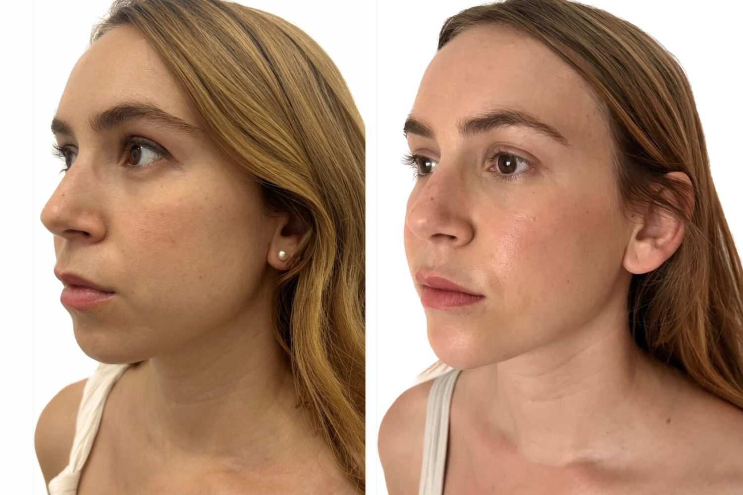 armonización facial chica antes después