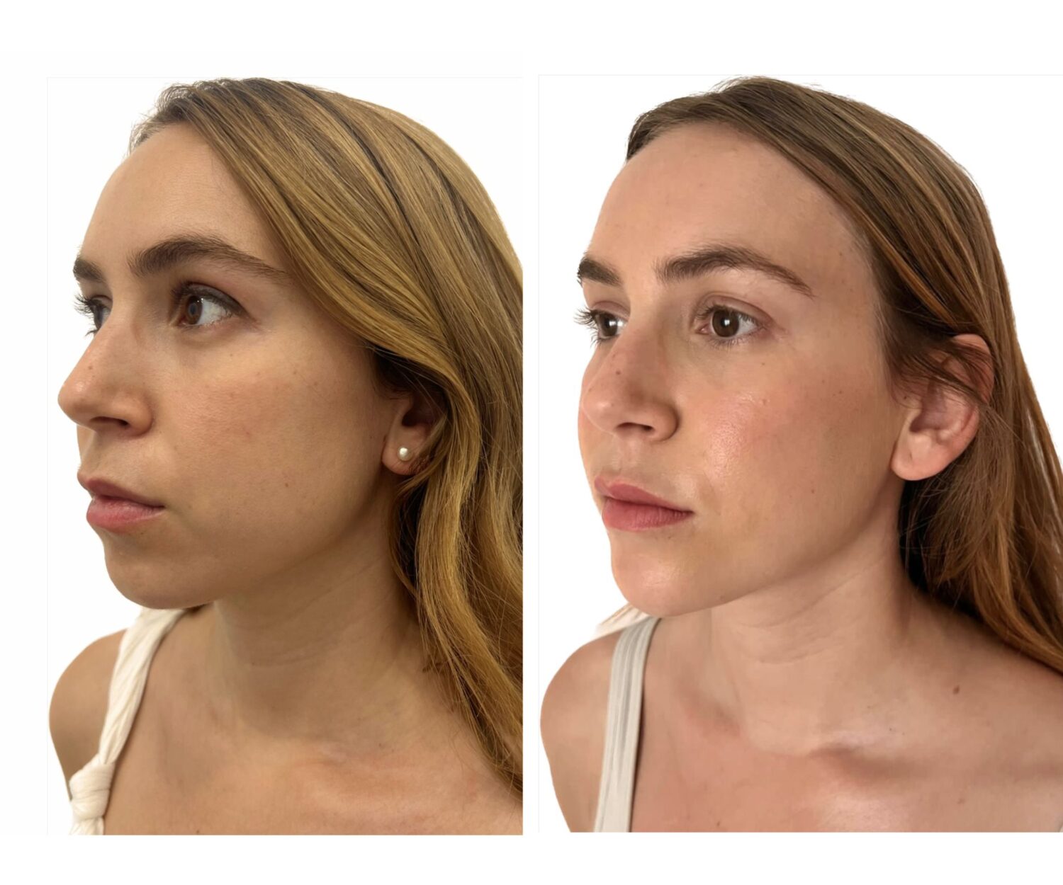 armonización facial chica antes después