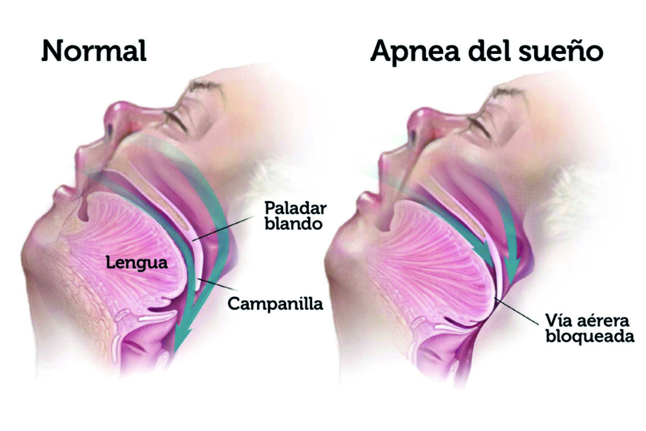 Solución Odontológica A La Apnea Del Sueño Clínica Dental Implantsite 9810