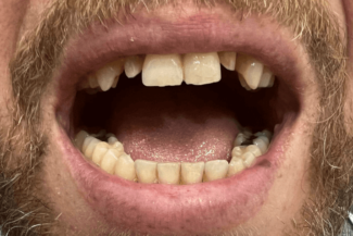 01 caso rea implante zirconio