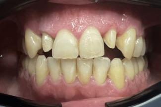 02 caso rea implante zirconio