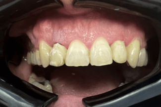 03 caso rea implante zirconio